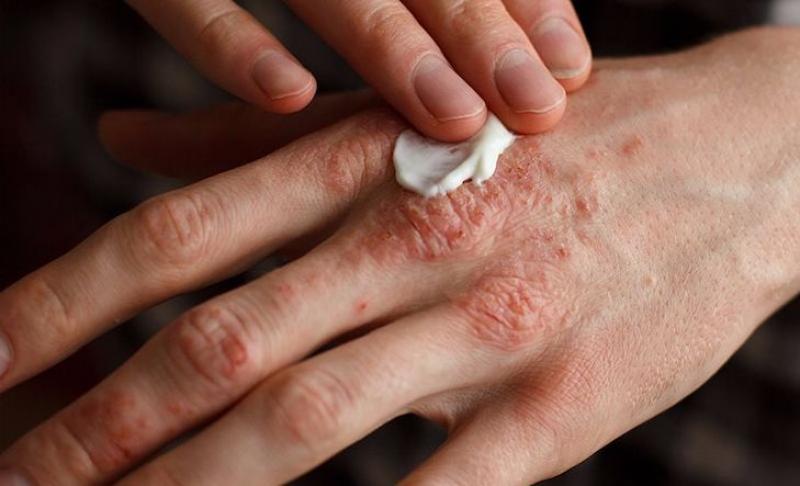 Cómo tratar la piel con psoriasis: consejos prácticos para aliviar los síntomas