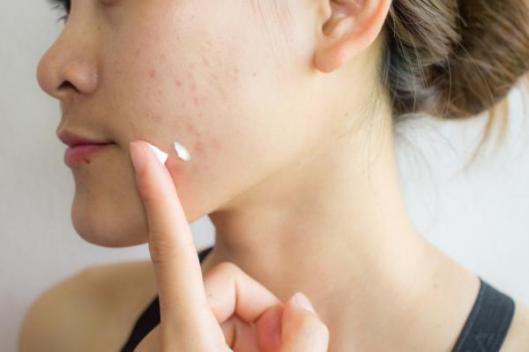 Cómo prevenir y tratar el acné: consejos prácticos y productos recomendados